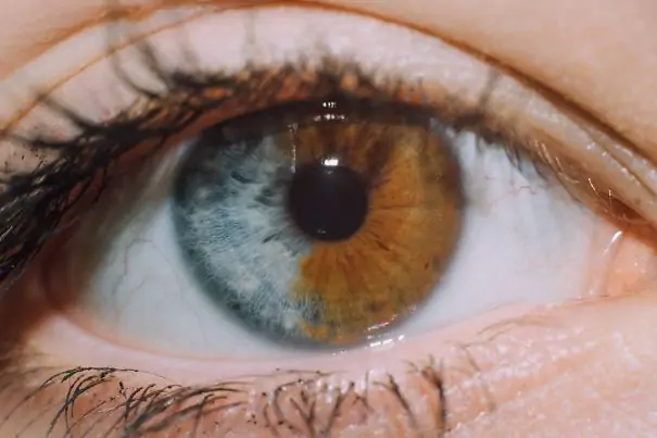 Heterochromia example 1
